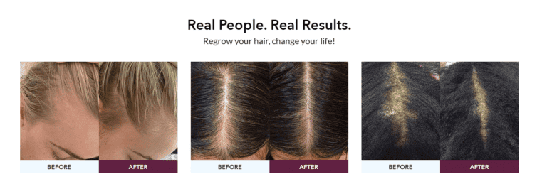 The Fully Vital Hair Growth System: Revitalize Your Crowning Glory